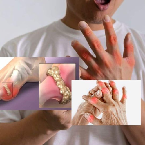 High Uric Acid Diet Program