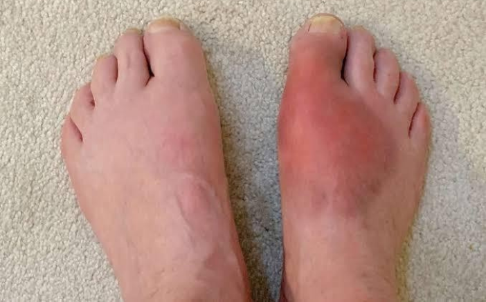 Foot Pain with Redness and Heat Gout or Infection