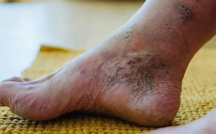 Foot Ulcers or Slow-Healing Sores: Diabetes or Circulatory Issues