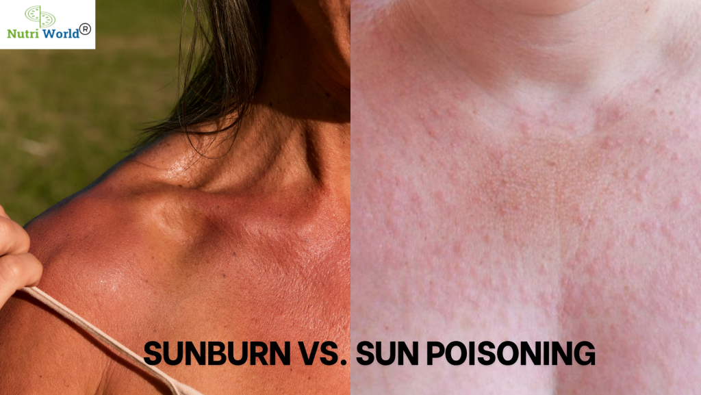 Sunburn vs. Sun Poisoning: What Your Skin Wants You to Know