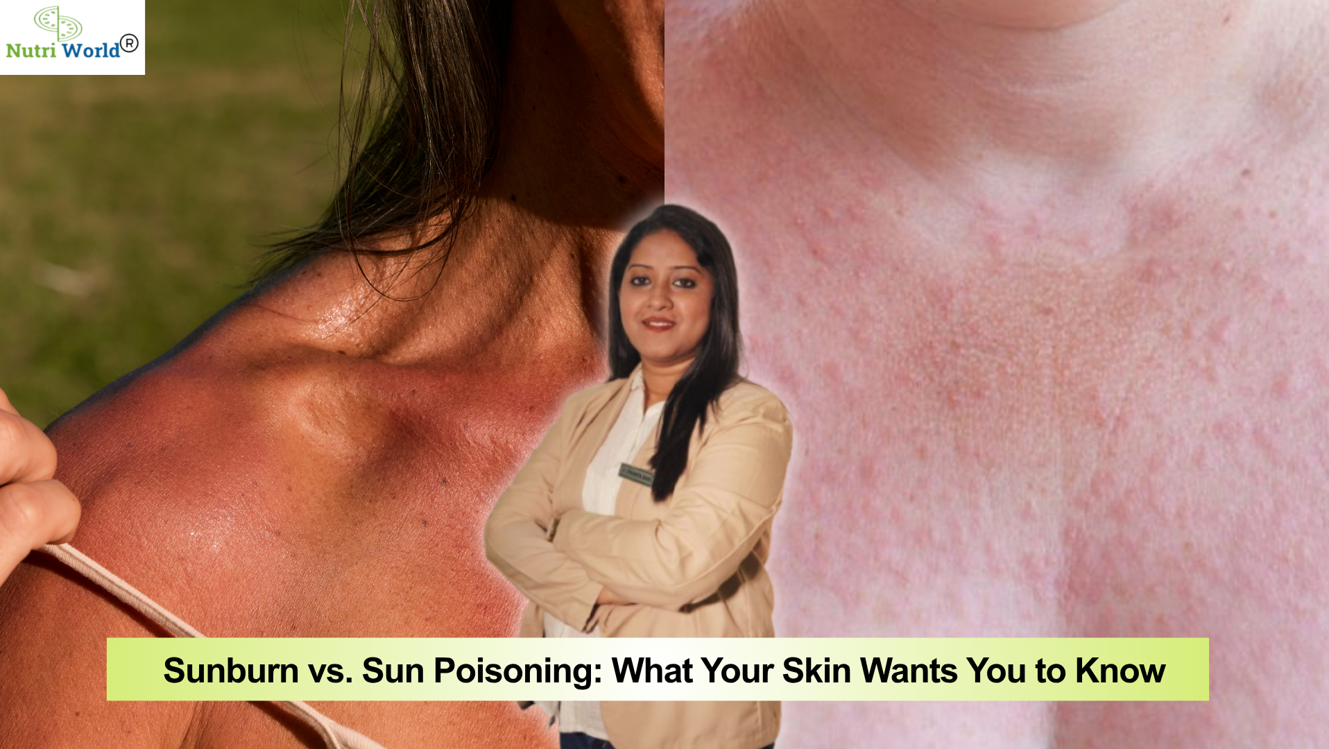 Sunburn vs. Sun Poisoning: What Your Skin Wants You to Know