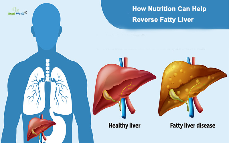 Fatty Liver Dietician in Kolkata: How Nutrition Can Help Reverse Fatty Liver
